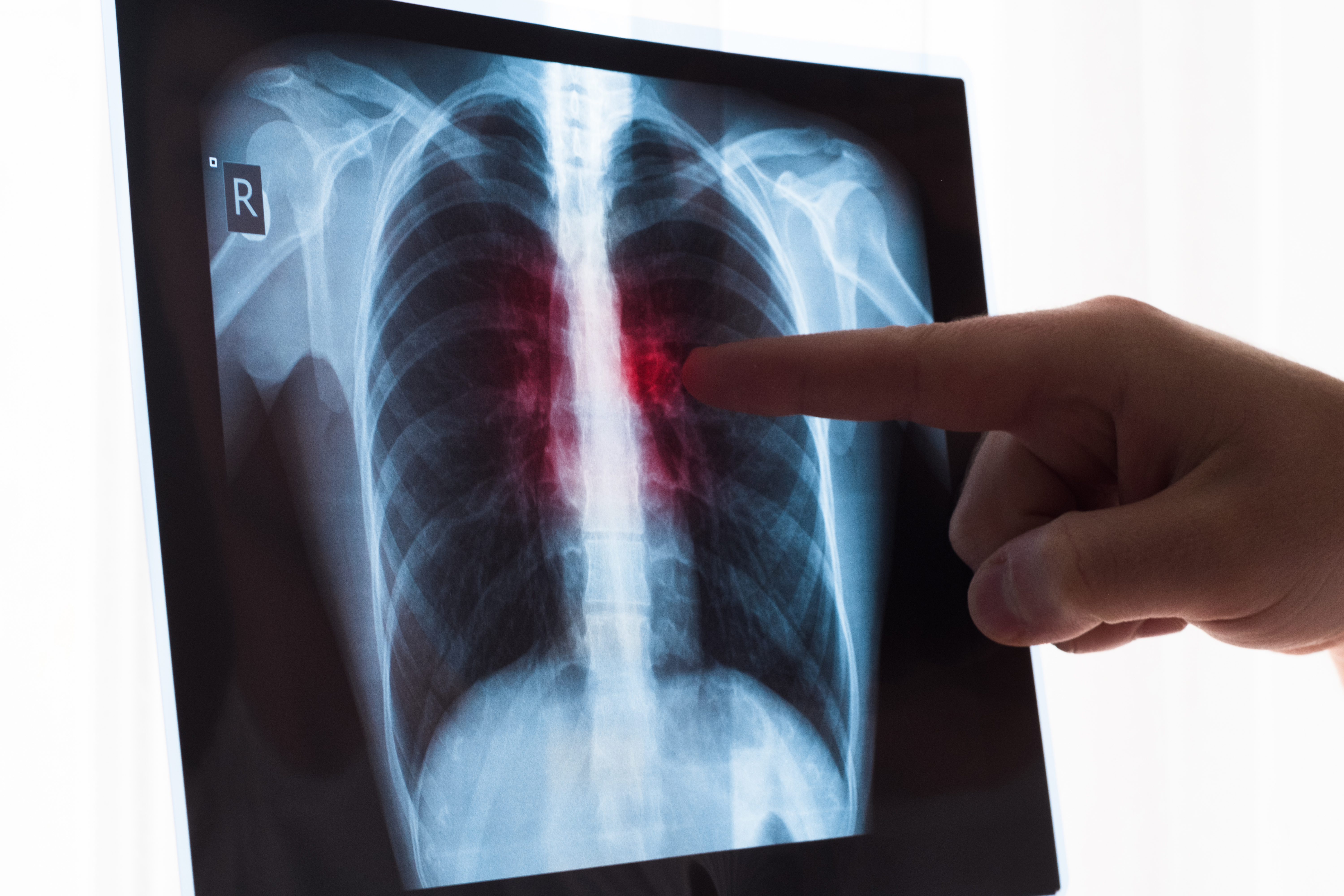 Patología de la coinfección TB / COVID-19: una amenaza fantasma